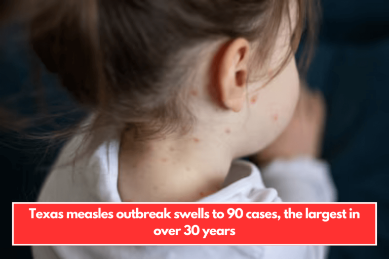 Texas measles outbreak swells to 90 cases, the largest in over 30 years